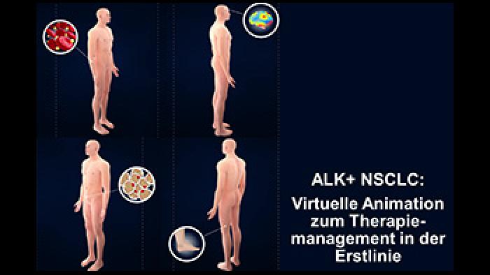 ALK+ NSCLC: Virtuelle Animation zum Therapiemanagement in der Erstlinie